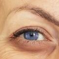 How Many Fillers Are Needed for Under the Eyes?